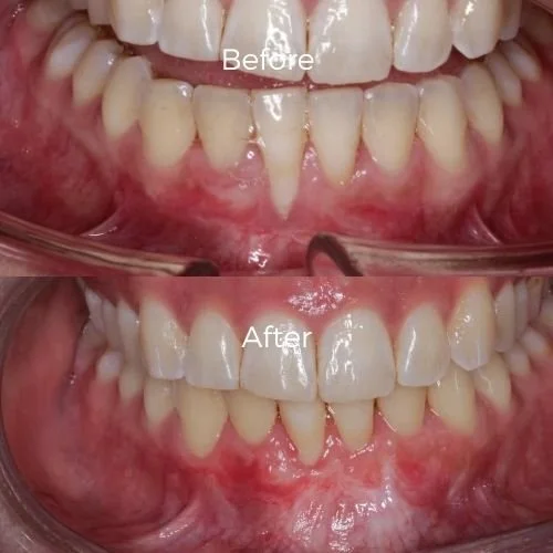 graft for gum recession​ before and after 12