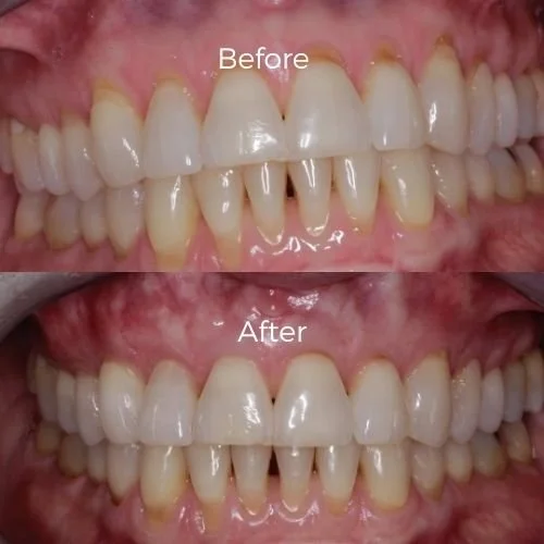 gum graft surgery before and after​ 14