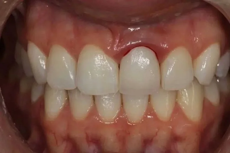 Close-up of bleeding gums in the upper section of a person's mouth.