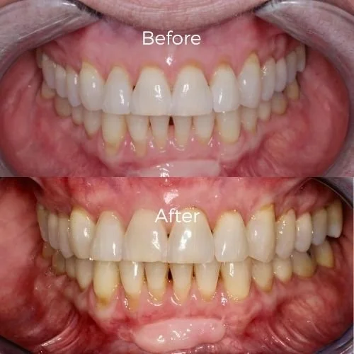 gum graft before and after​ 4