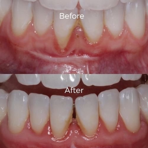 gum graft before and after​ 7