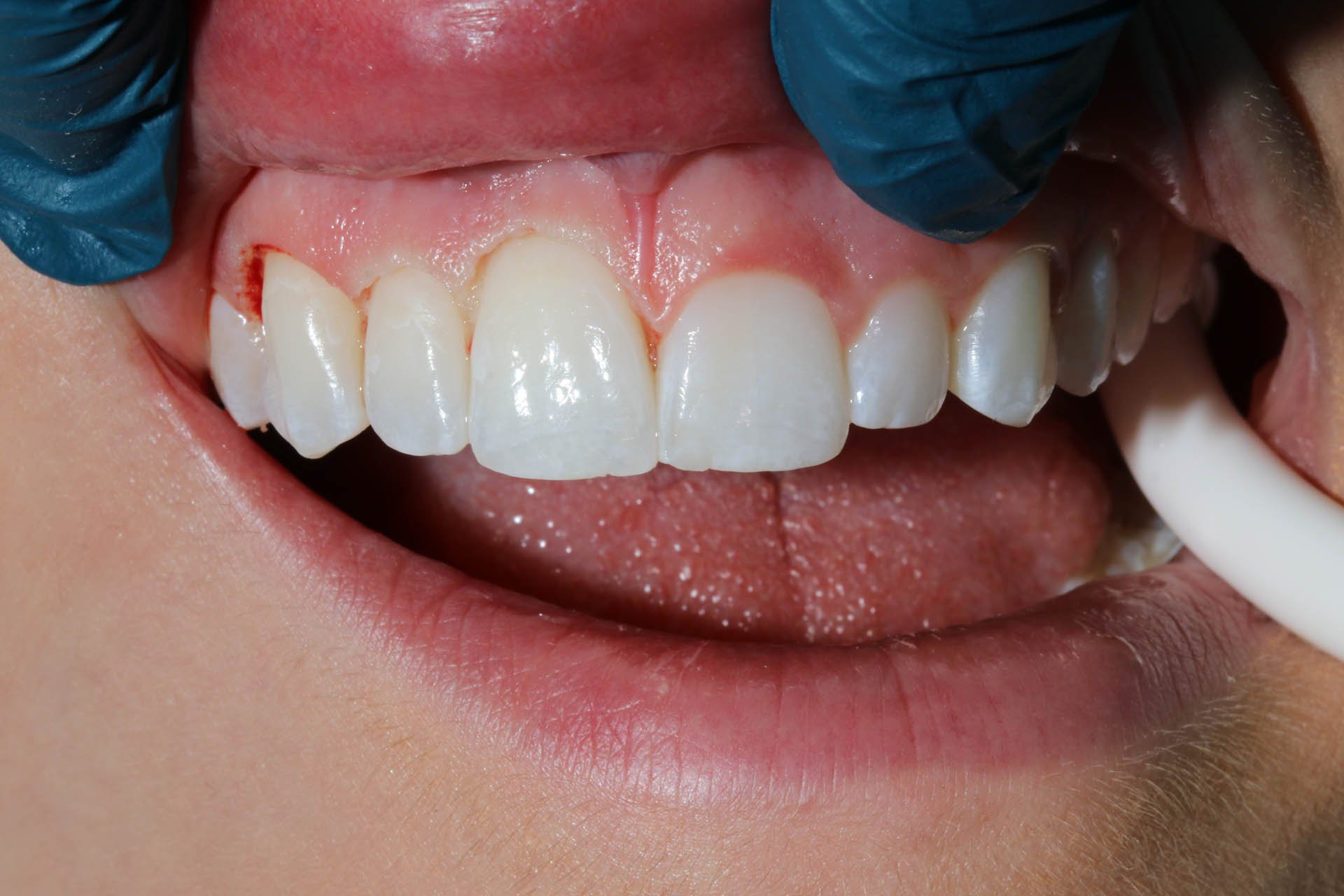 during - esthetic crown lengthening surgery with a laser