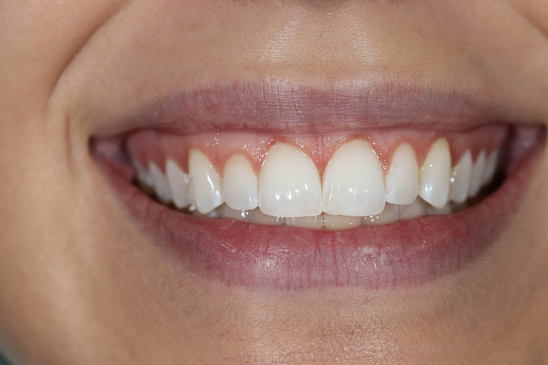 before - esthetic crown lengthening surgery with a laser
