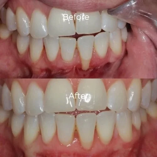 Before and After Gum Grafting with Dr Scott Froum