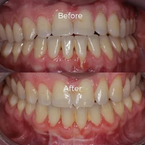 gum graft surgery before and after​ 2