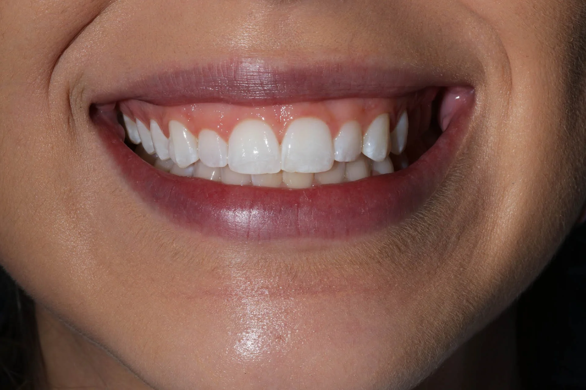 after - esthetic crown lengthening surgery with a laser