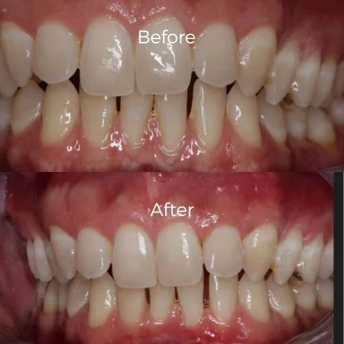 gum graft surgery before and after​ 8