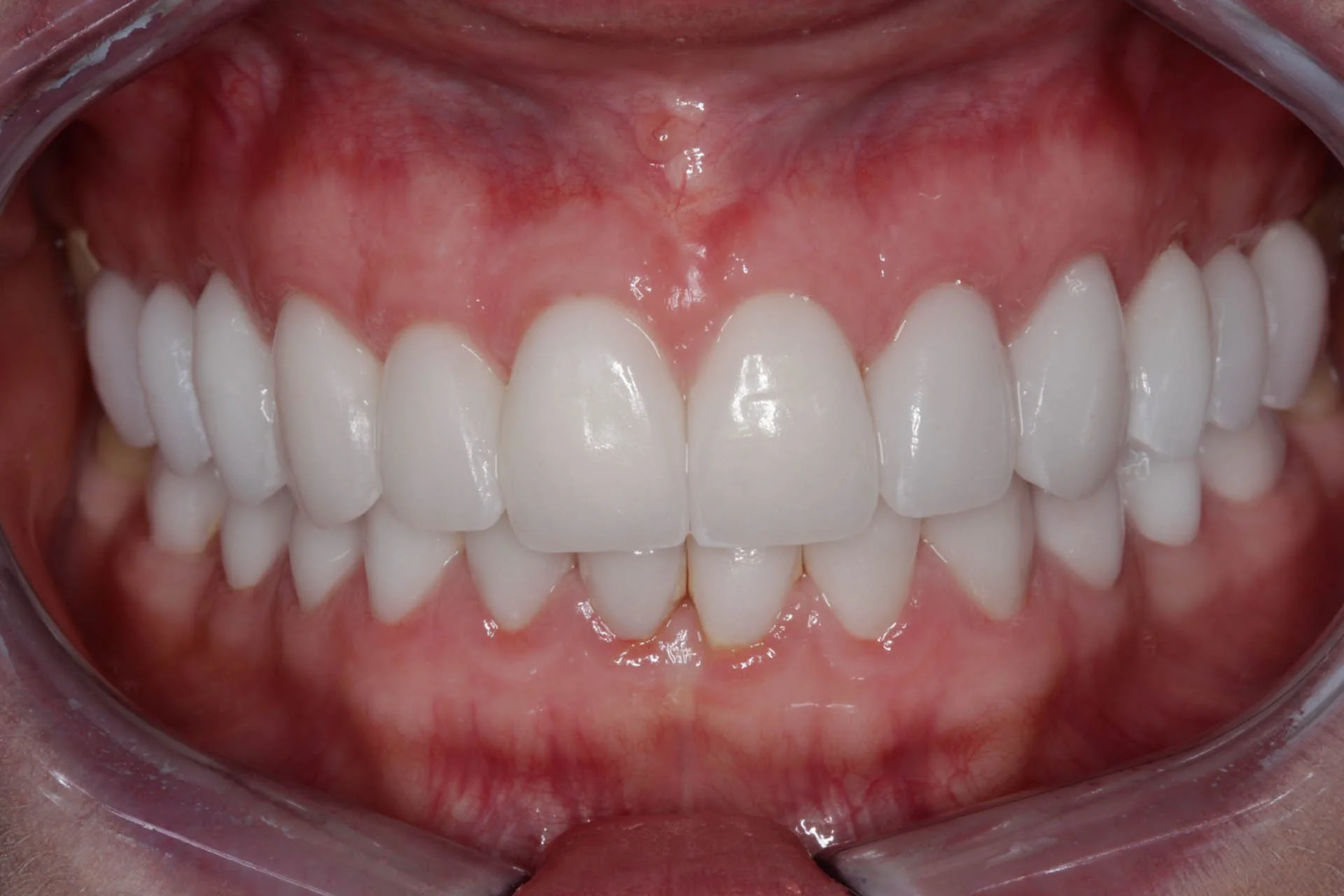 inflamed veneers after laser gum treatment