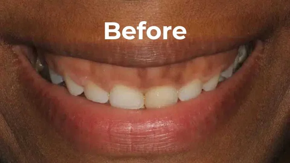 Gummy Smile Before
