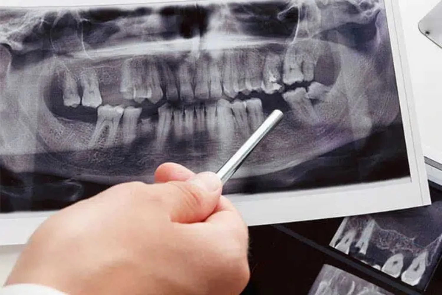 Image of Xray showing missing tooth