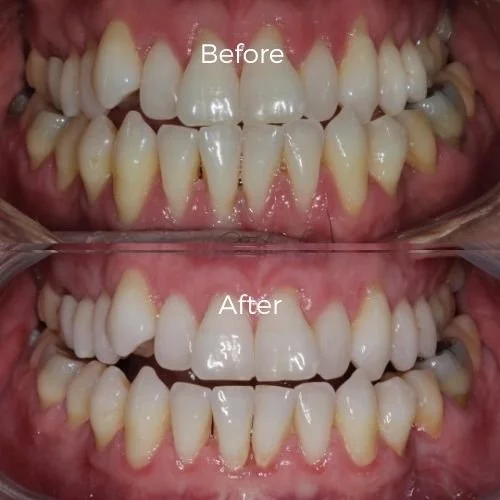 gum graft surgery before and after​ 11