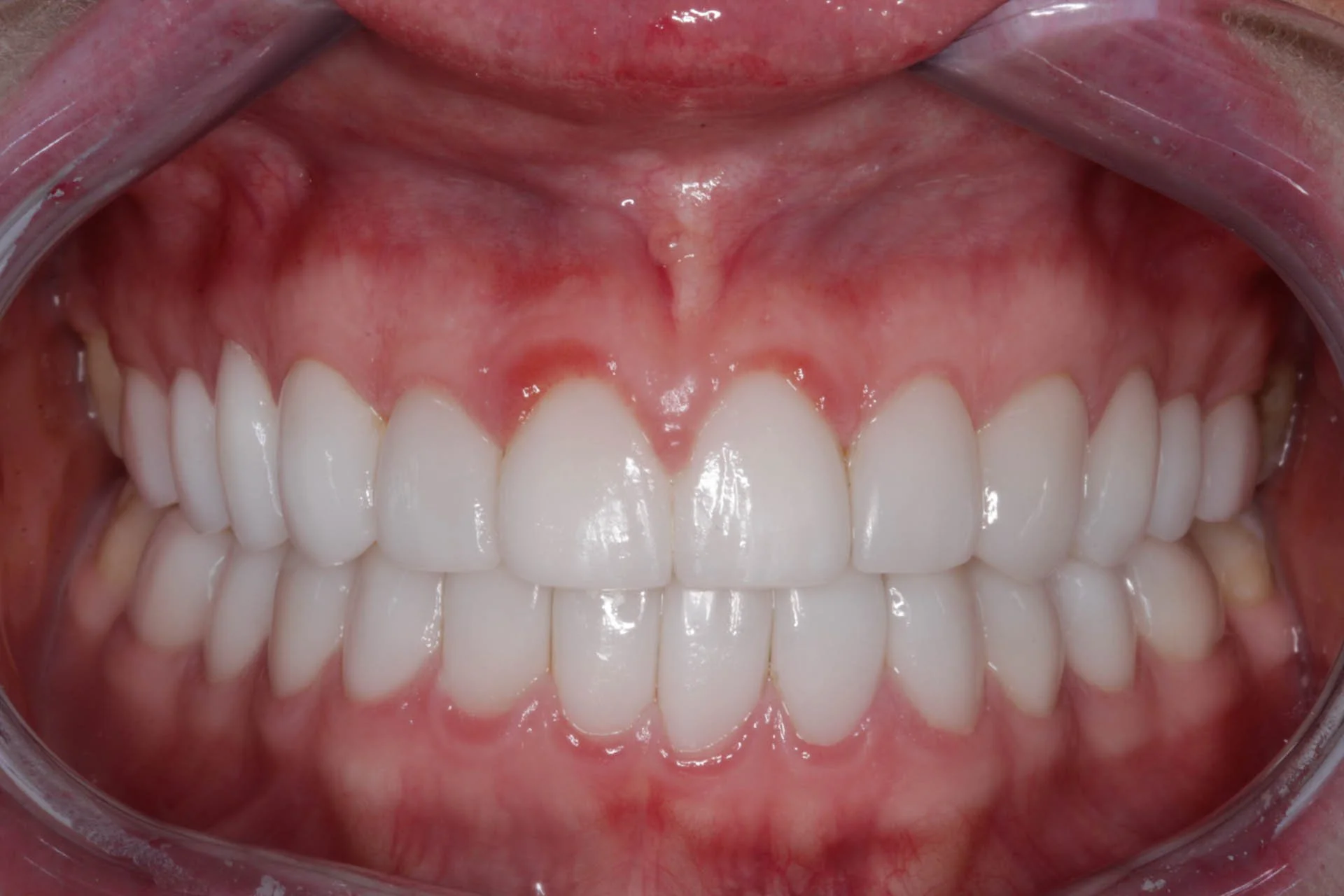 inflamed veneers before laser gum treatment