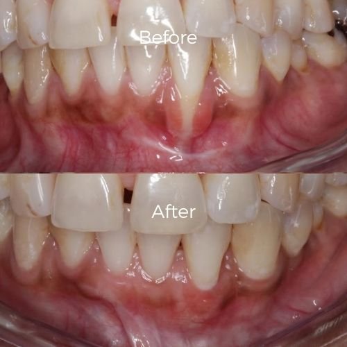 graft for gum recession​ before and after 6