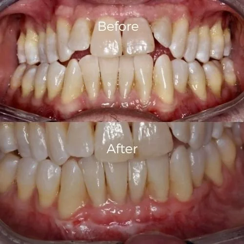dental bone graft results