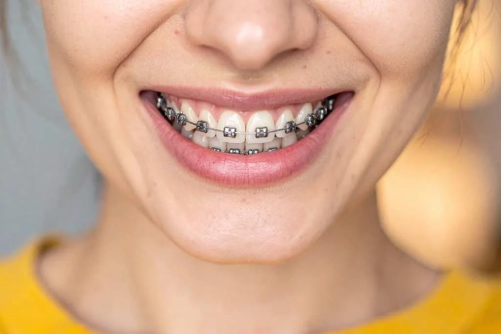 Who Is a Good Candidate for Gum Grafting?