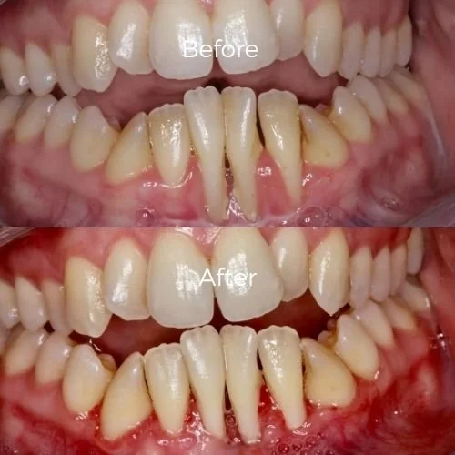 Gum Grafting before and after to combat gum recessions