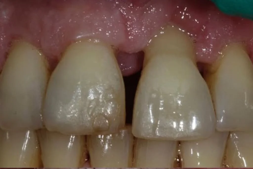 Before Saving Teeth Treatment at Dr. Scott Froum's periodontist practice.