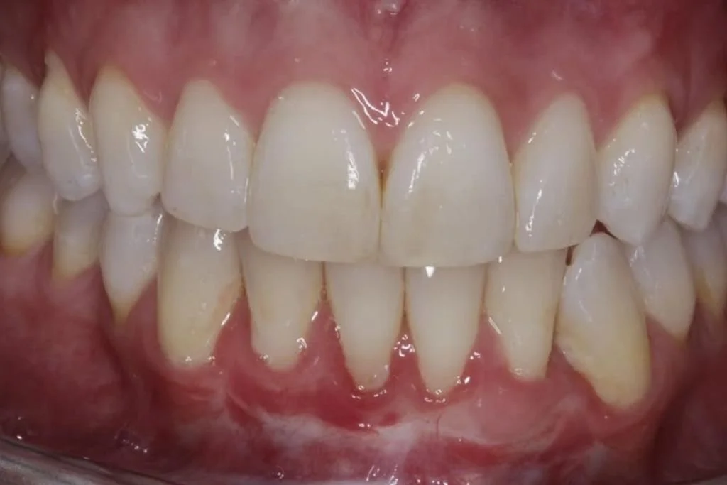 After gum graft with the best periodontist in NYC