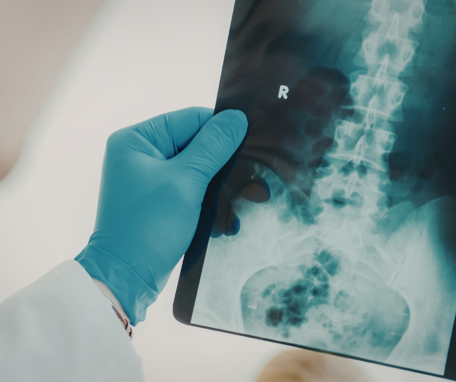 Spinal Stenosis: Understanding Narrowing in the Spine