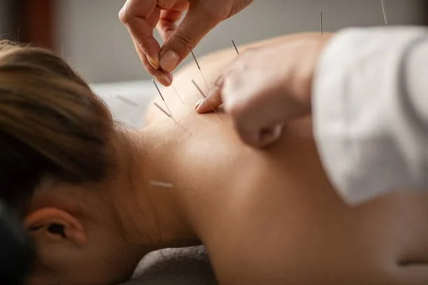 acupuncture needles being placed on the neck and upper back of a patient