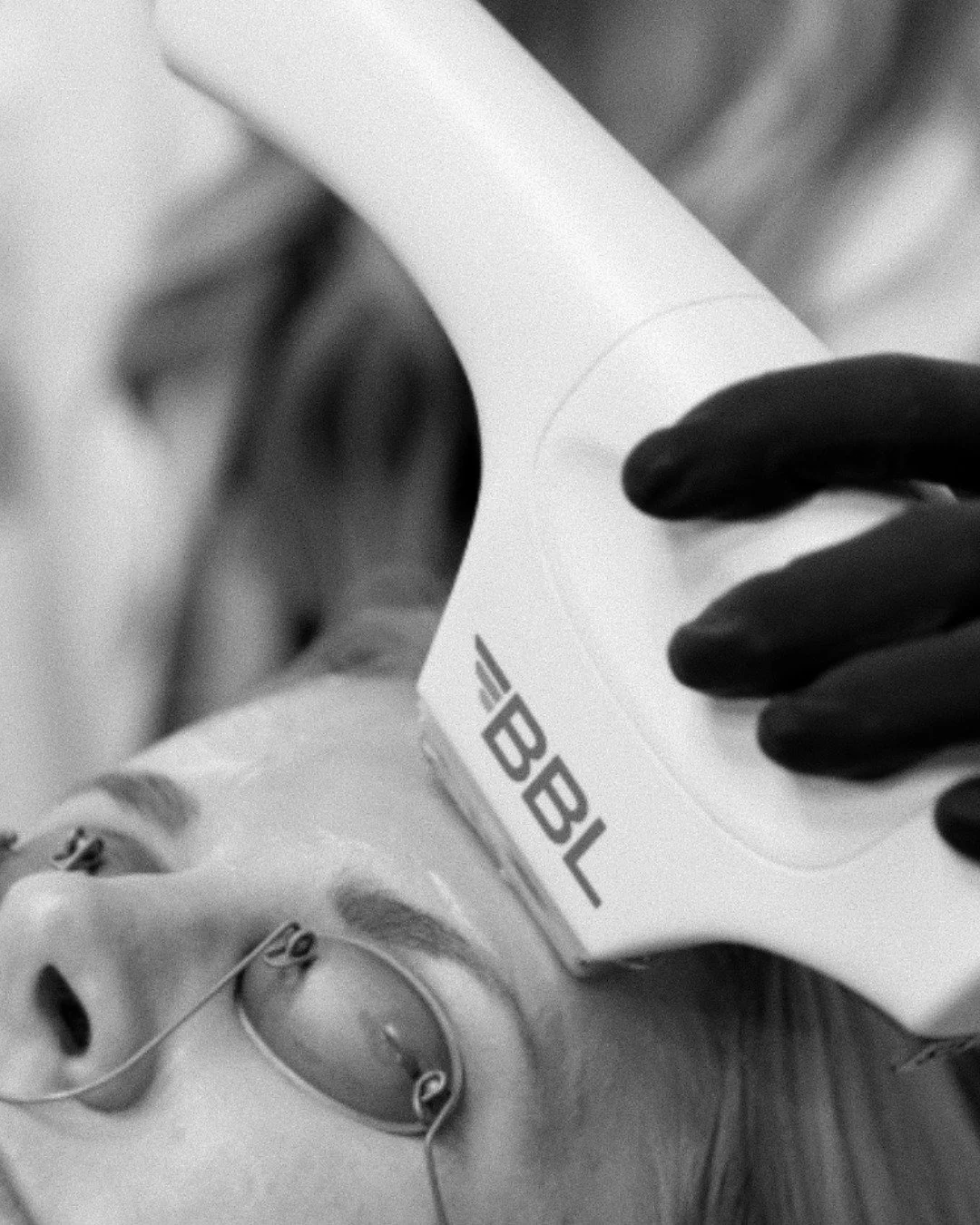 Cada piel es distinta, y el primer paso es conocer la tuya.

Agenda tu evaluaci&oacute;n para BBL y recibe una valoraci&oacute;n personalizada para saber si este tratamiento es ideal para ti y qu&eacute; resultados puedes esperar.

Empieza hoy. Agend