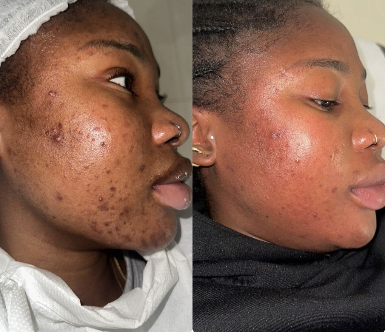 Side-by-side comparison of a woman’s face before and after acne treatment. The left side shows significant acne and scarring, while the right side shows clearer, smoother skin.