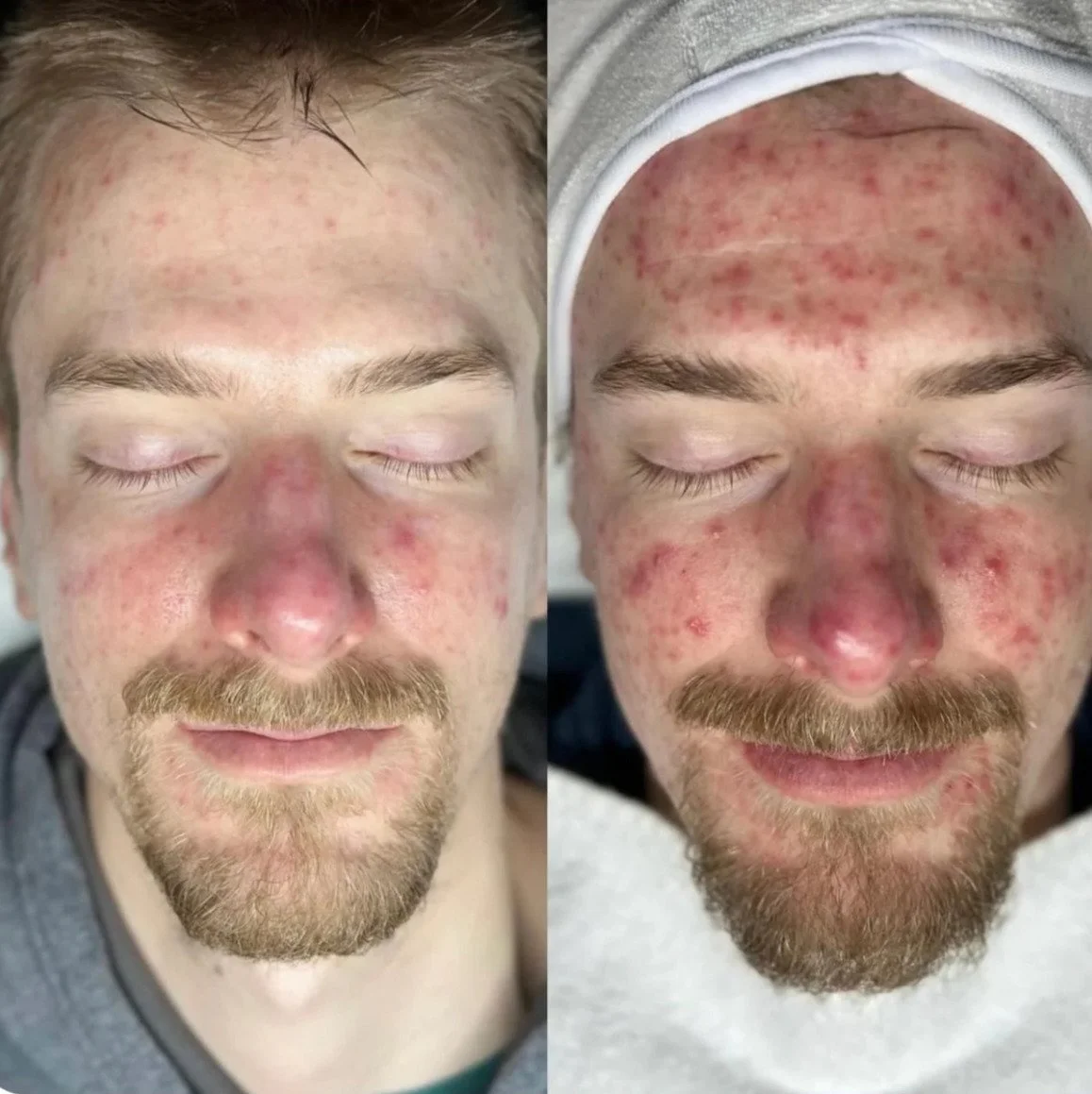 Comparison of a man's face before and after a skincare treatment, showing reduced redness and inflamed skin.