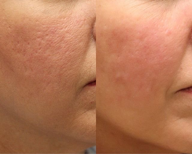 Close-up of a person's cheek showing a before and after comparison of skin texture and redness.