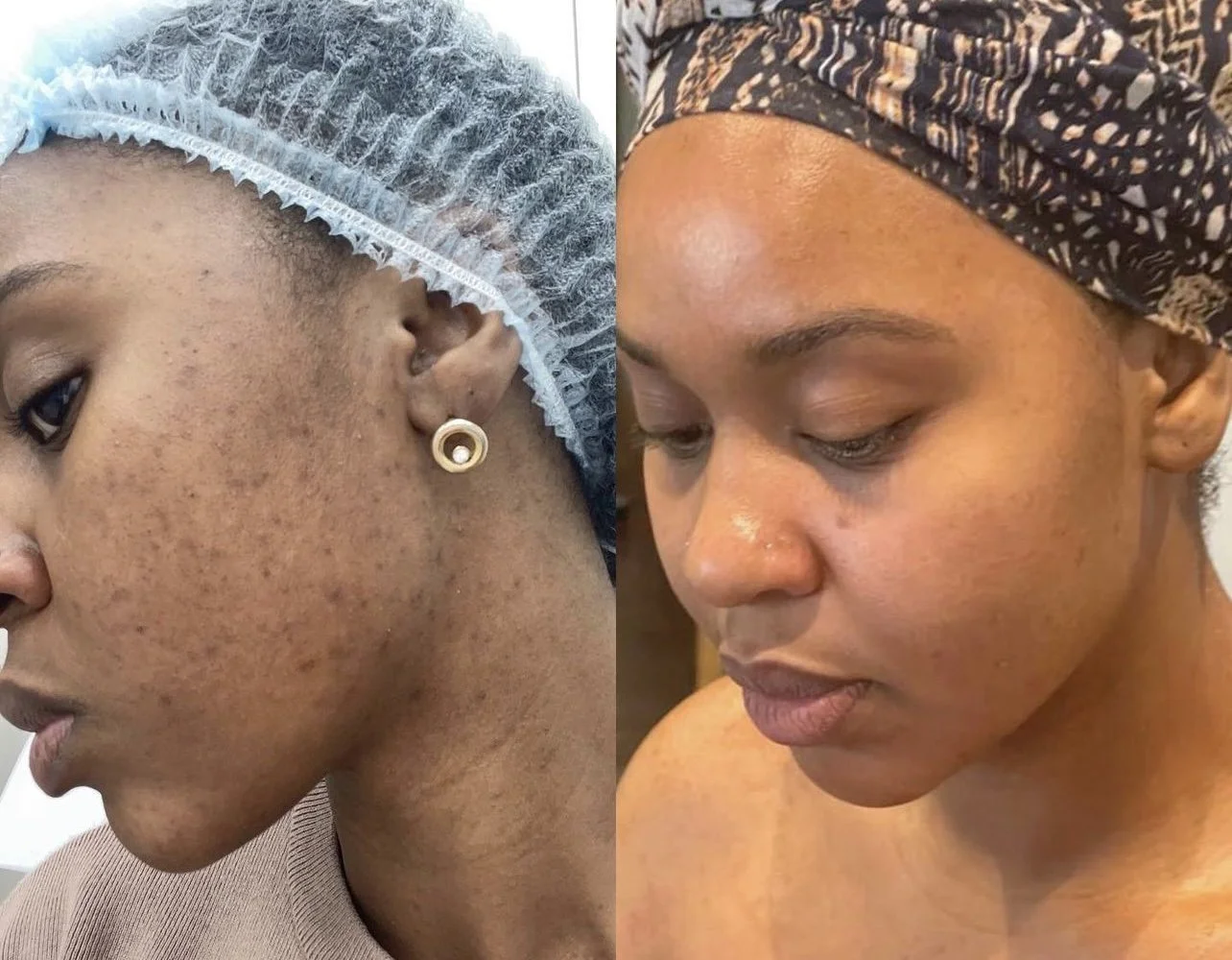 Comparison of a woman's face with severe skin acne and scars on the left and clearer, smoother skin on the right.