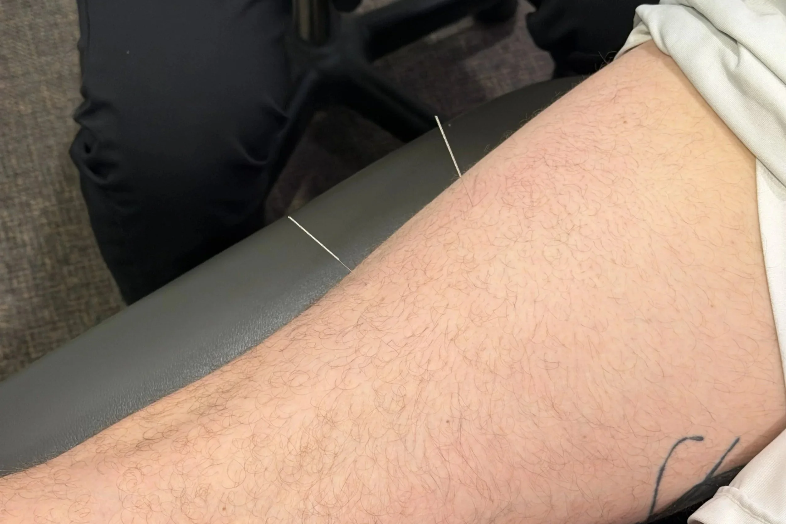 A person receiving an acupuncture treatment, with thin acupuncture needles inserted into their skin.