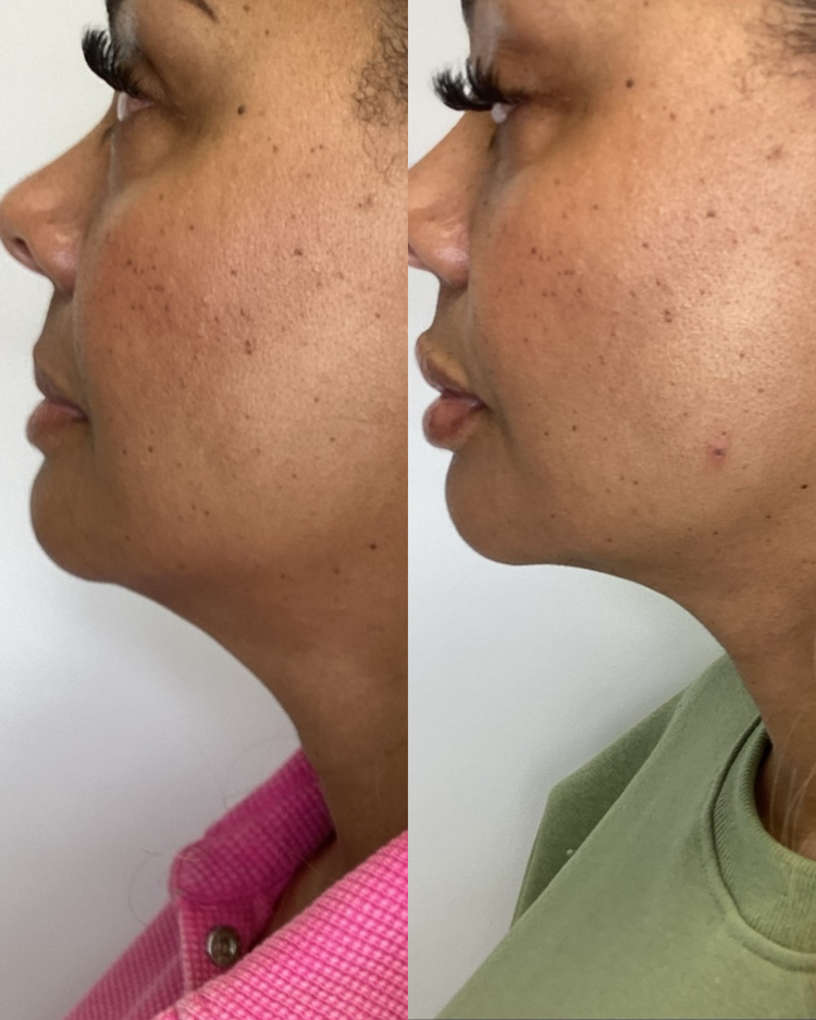 Before-and-after skin photos from Infinite Med Spa’s patient gallery