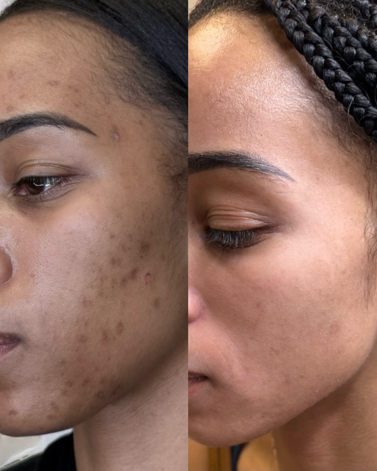 Before-and-after skin photos from Infinite Med Spa’s patient gallery