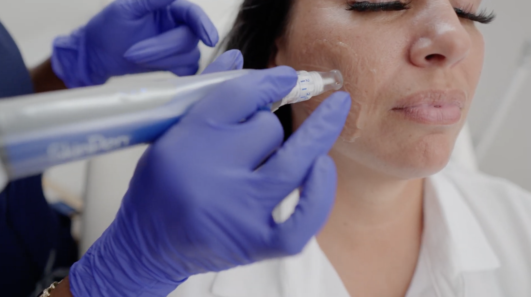 Microneedling for Acne Scars in Slidell LA