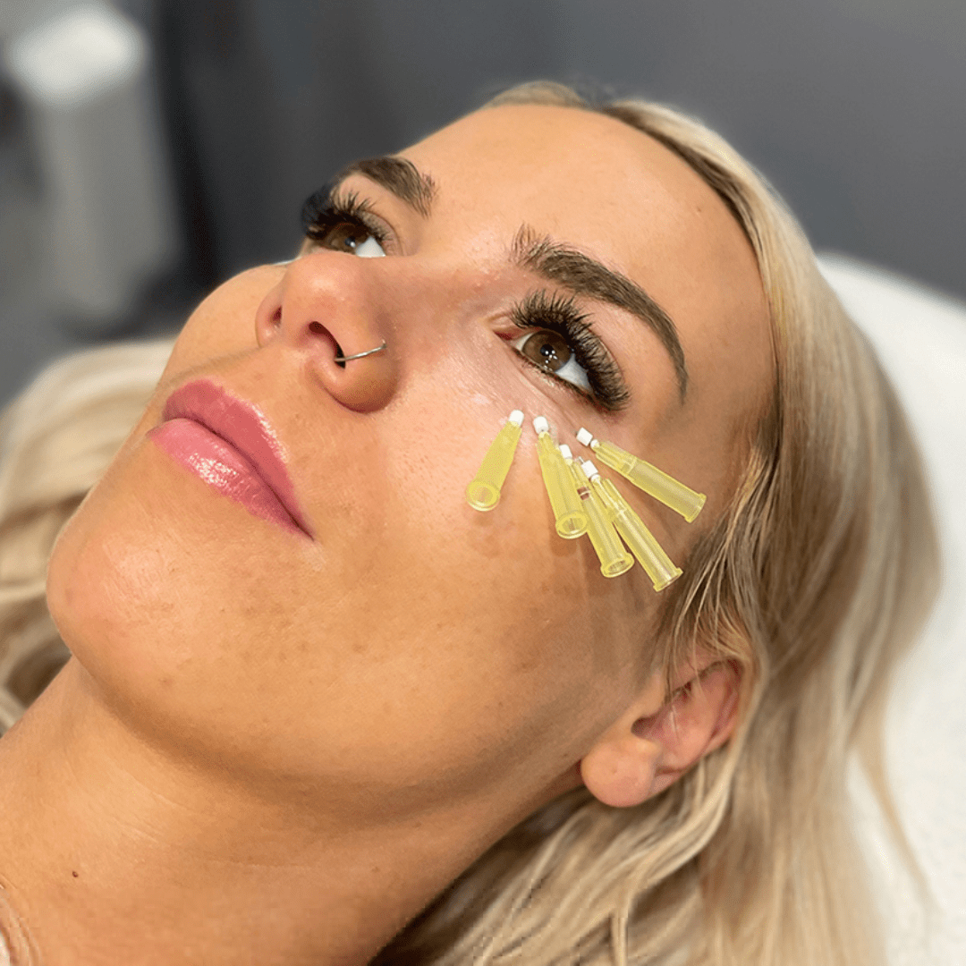 PDO Thread Lift in Slidell, LA: What to Expect