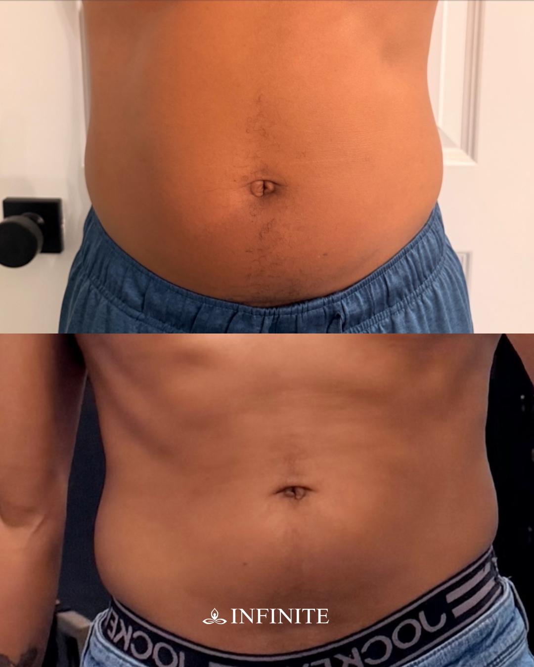 Before and after image of a patient who received Endolaser and saw significant fat loss in their abdomen