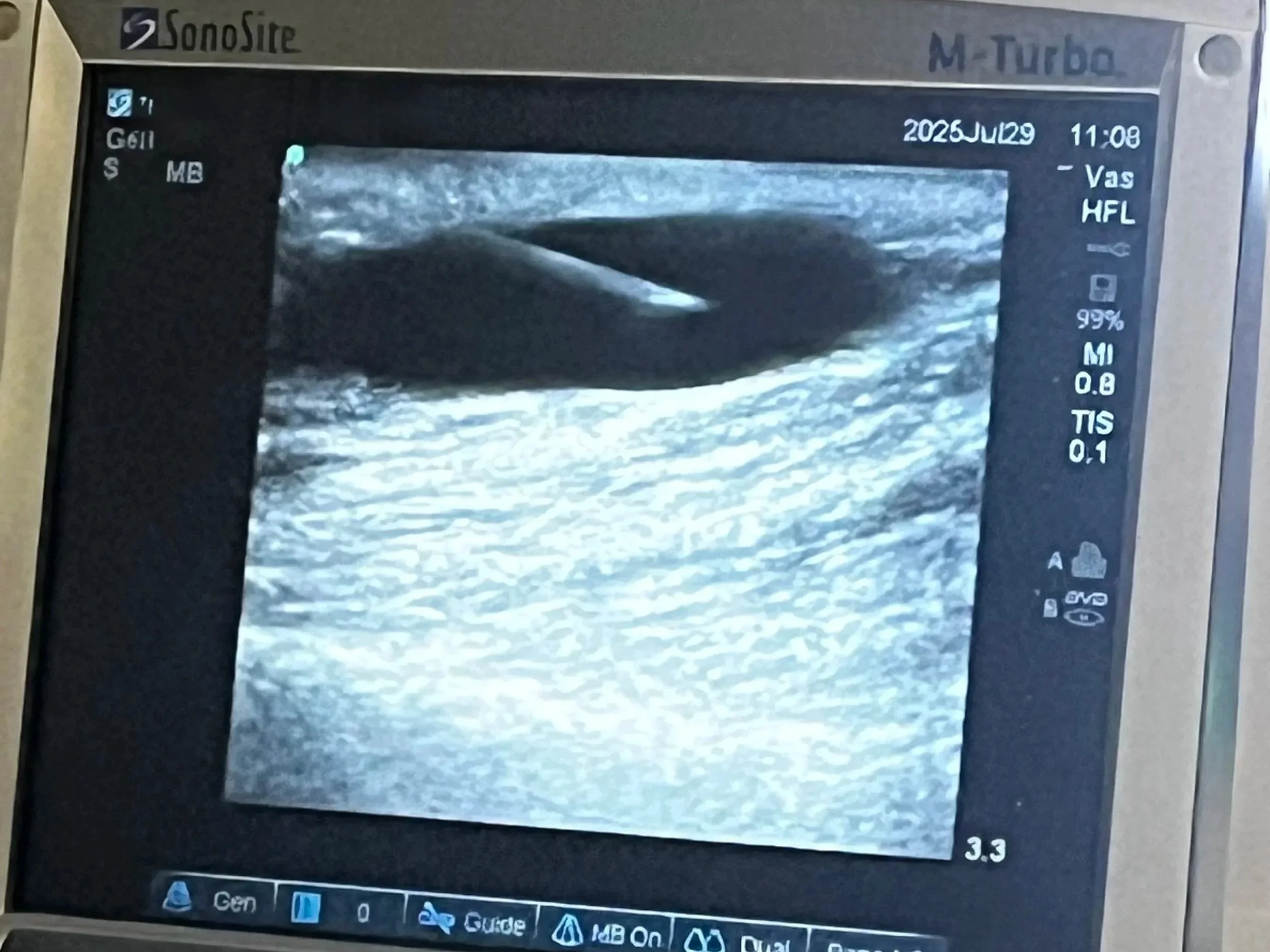 Needle being inserted using ultrasound guidance into patient's arm for dialysis.