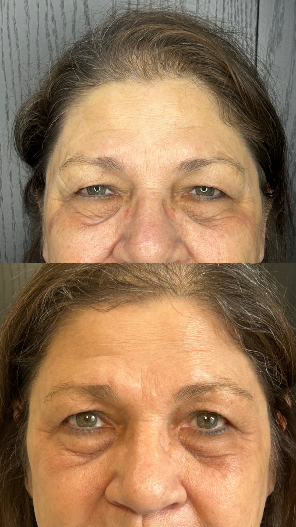 Plasmage - upper & lower eyes