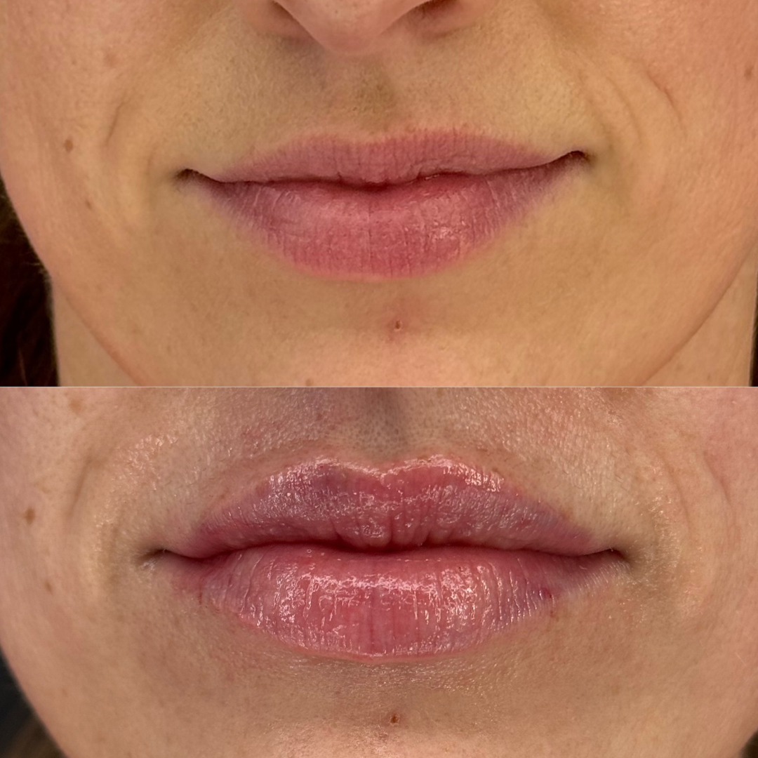 Lip Filler