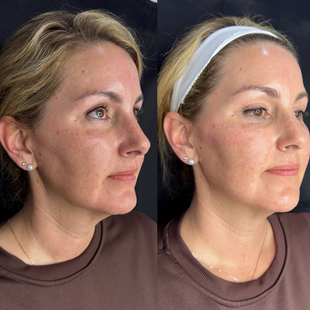 Filler - Facial Balancing