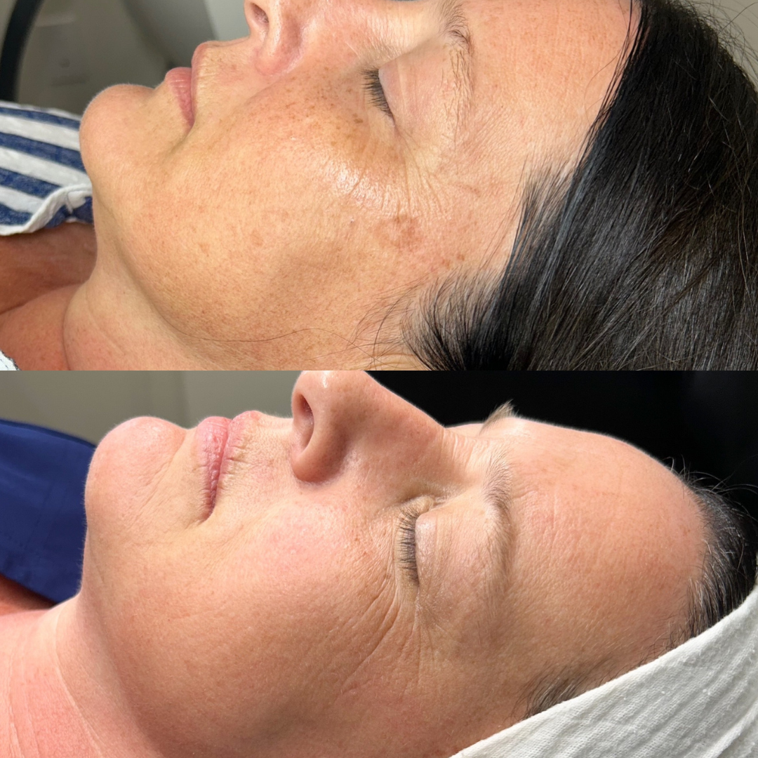 Bright & Tight Laser Treatment