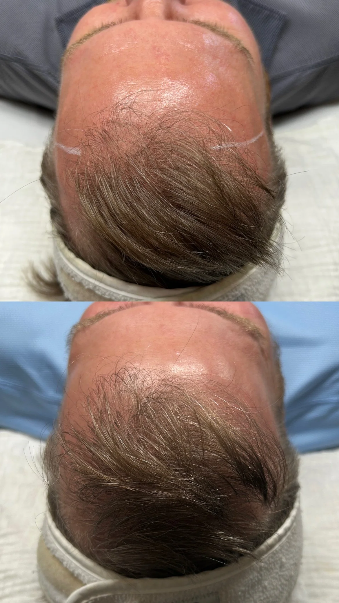 Hair Restoration - 2 months after mircroneedling + Derive