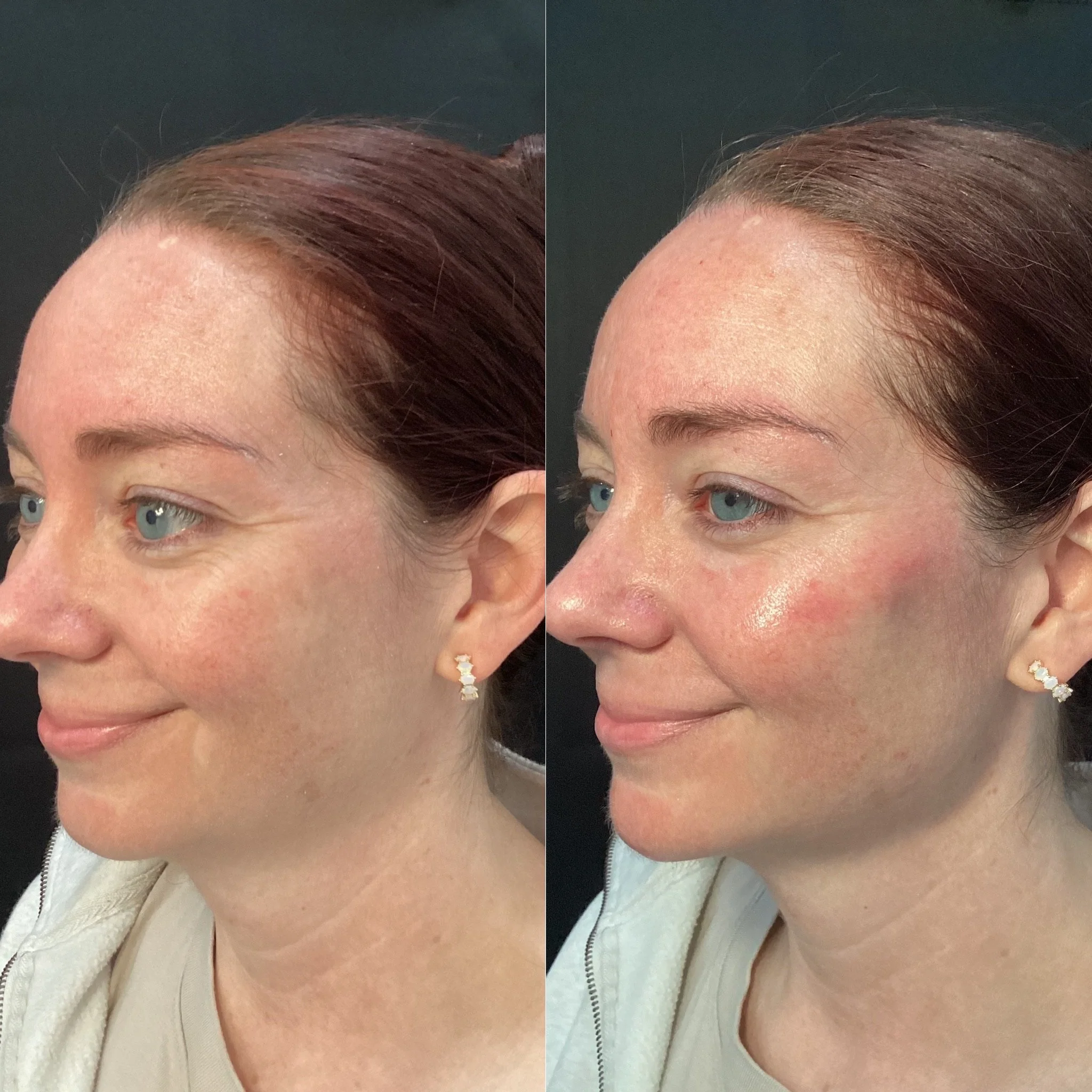 Radiesse Filler - cheeks, jaw, chin