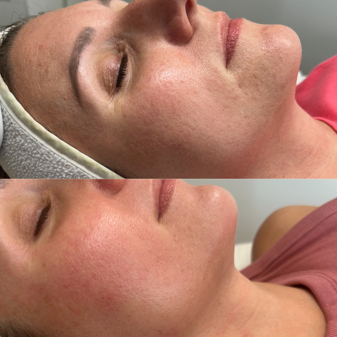 skinpen Microneedling