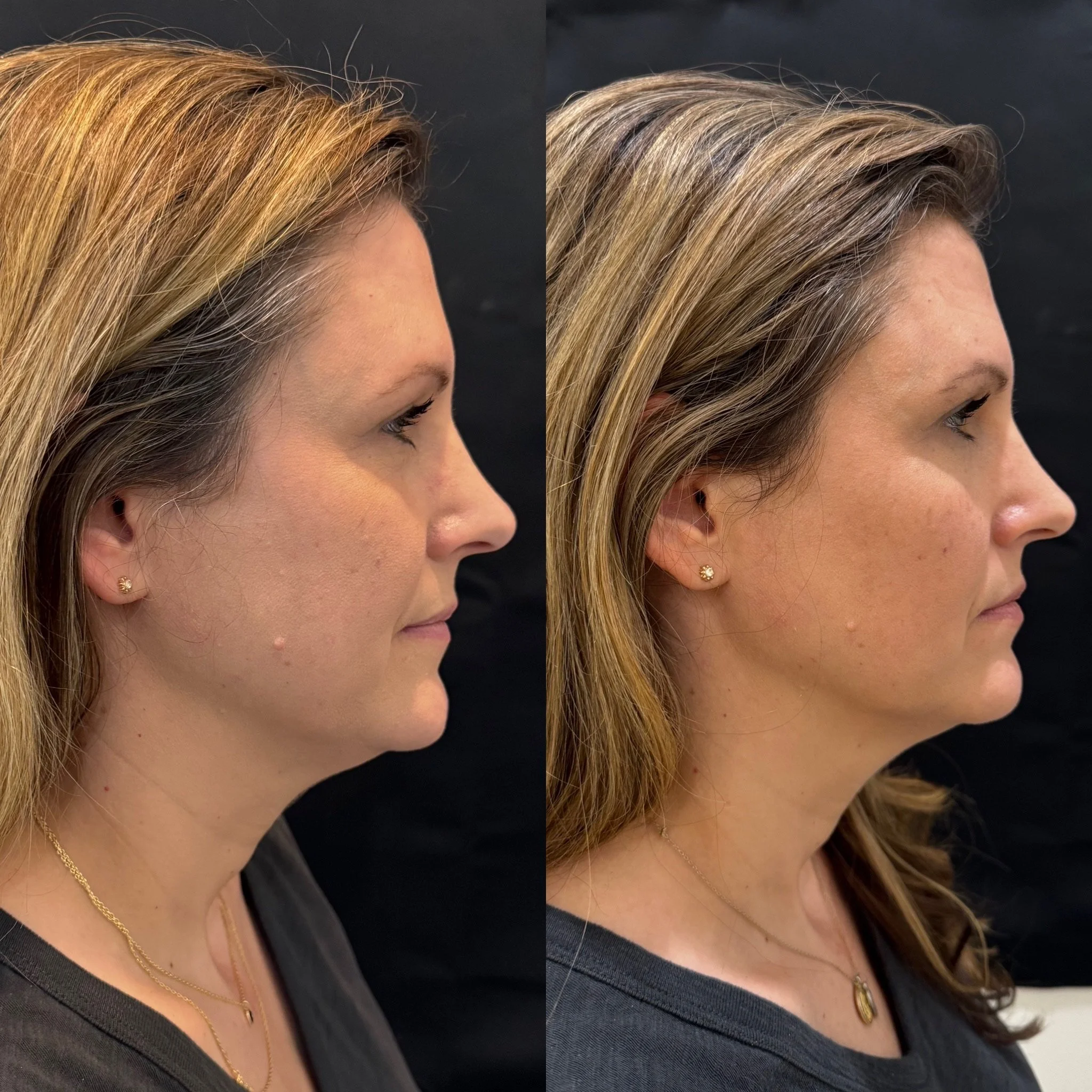 Filler - cheeks, jawline & temples