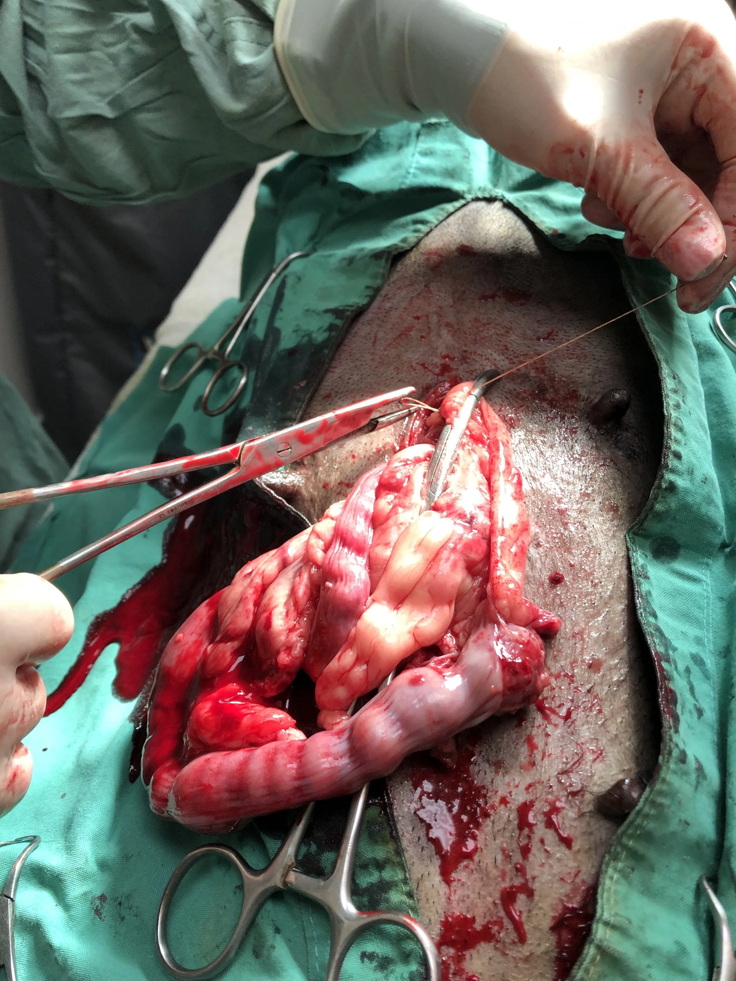 A surgical procedure showing a large incision with exposed intestines, surgical tools, and gloved hands performing an operation.
