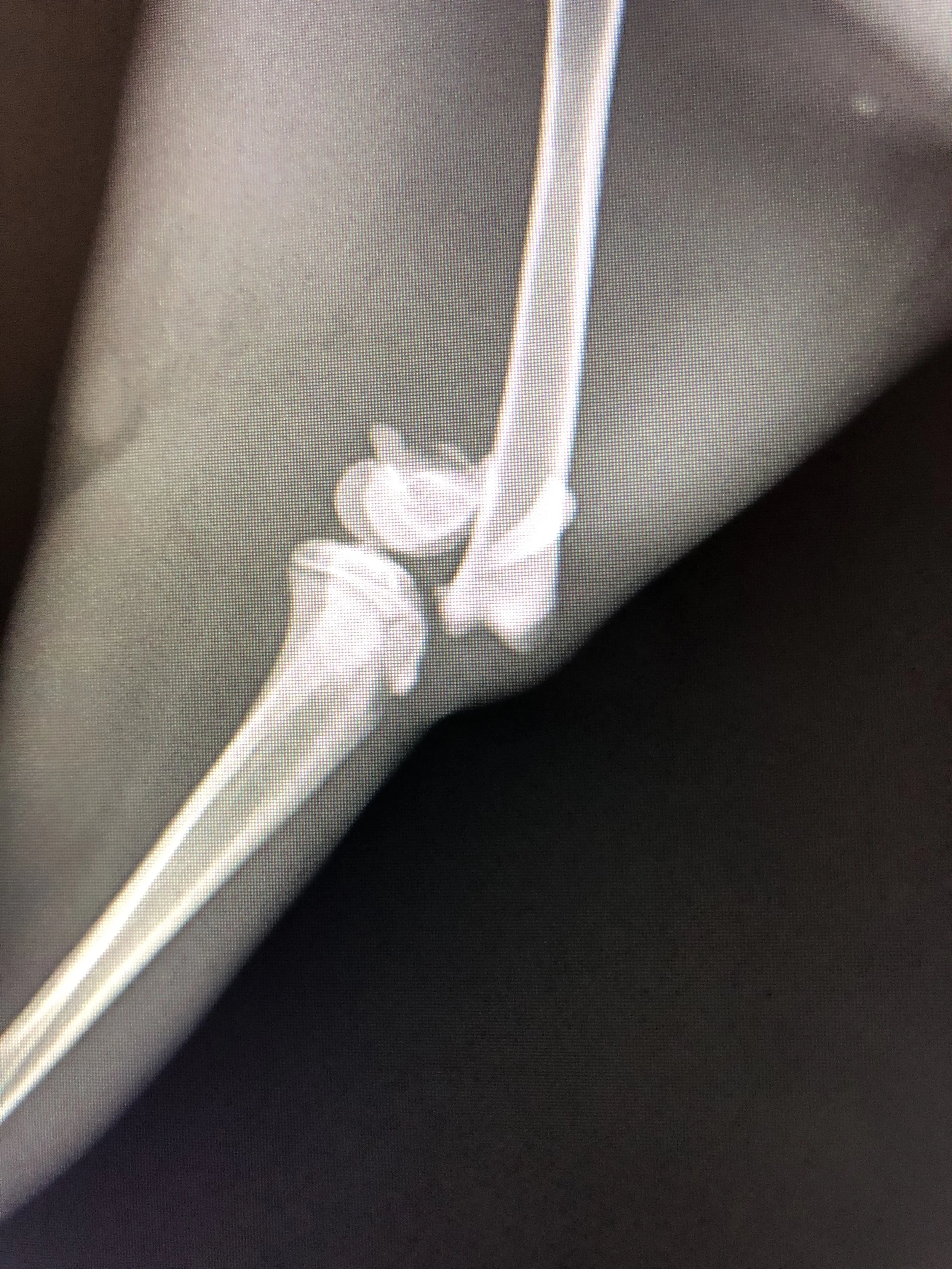 X-ray image showing a broken bone in the lower leg with a fracture and displacement.