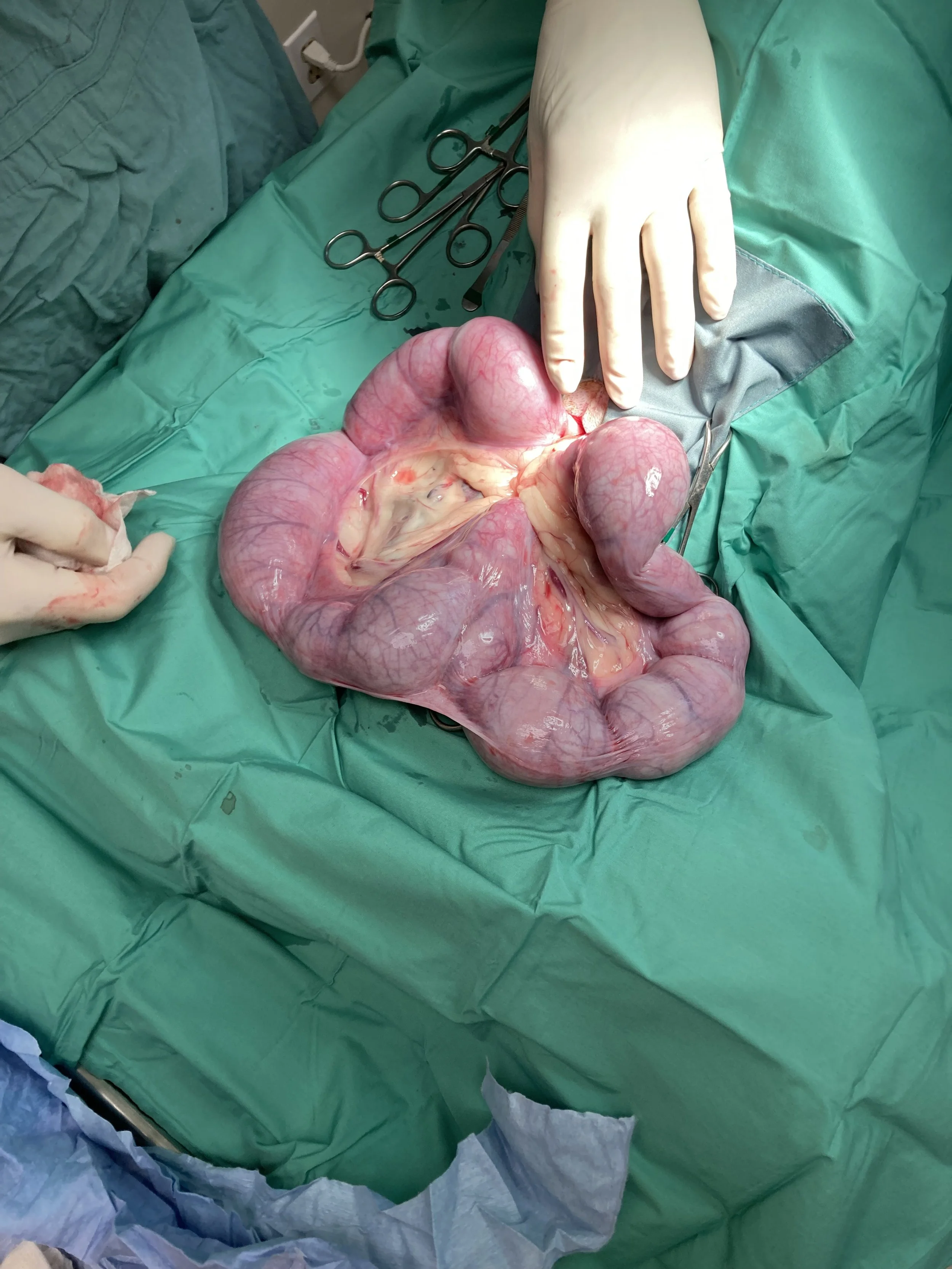 During surgery, a large, twisted intestine with a looped and swollen appearance is visible, with surgical tools and gloved hands around it on a green surgical drape.