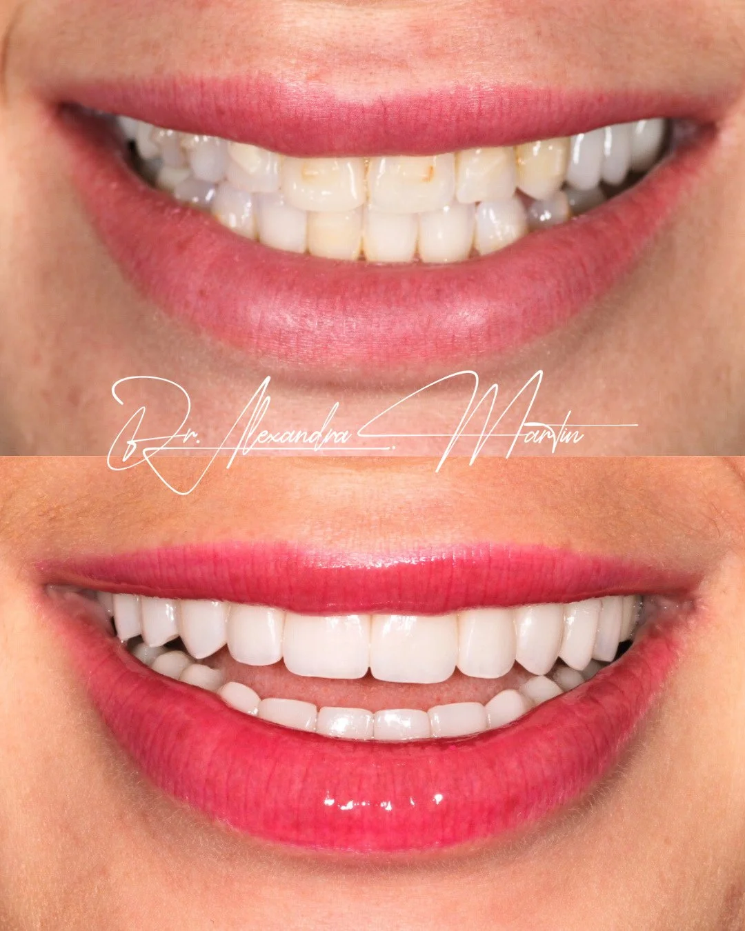 This case combined alignment, restoration, and thoughtful design to support both function and aesthetics! After completing Invisalign treatment, we used a customized mix of crowns and minimal to no prep veneers on the upper 10 and lower 10 teeth to r