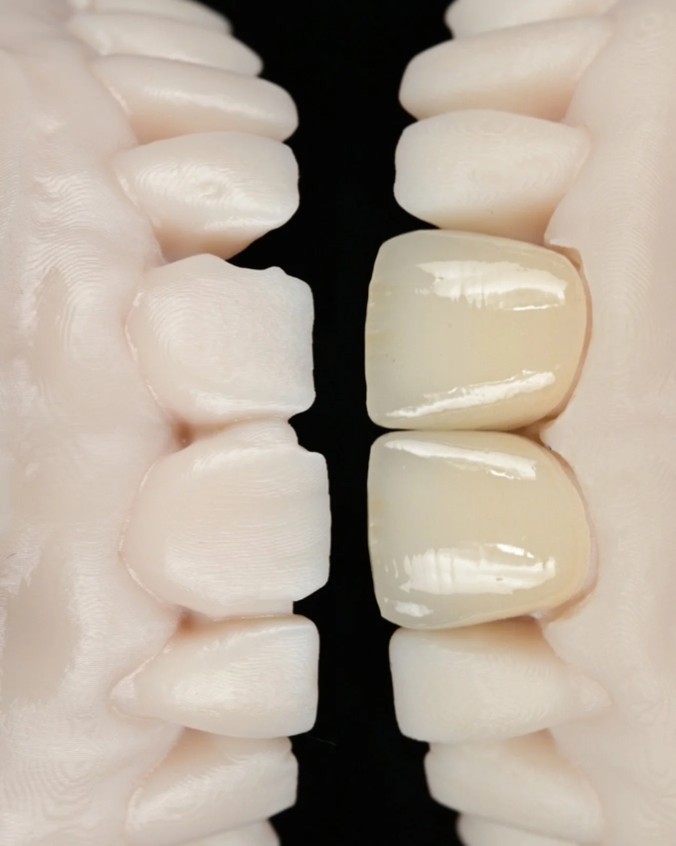 This case involved two veneers.

Worn edges were rebuilt and failing fillings were replaced. The greater challenge was not making the teeth brighter, but matching the translucency, surface texture, and light behavior of the surrounding enamel so the 