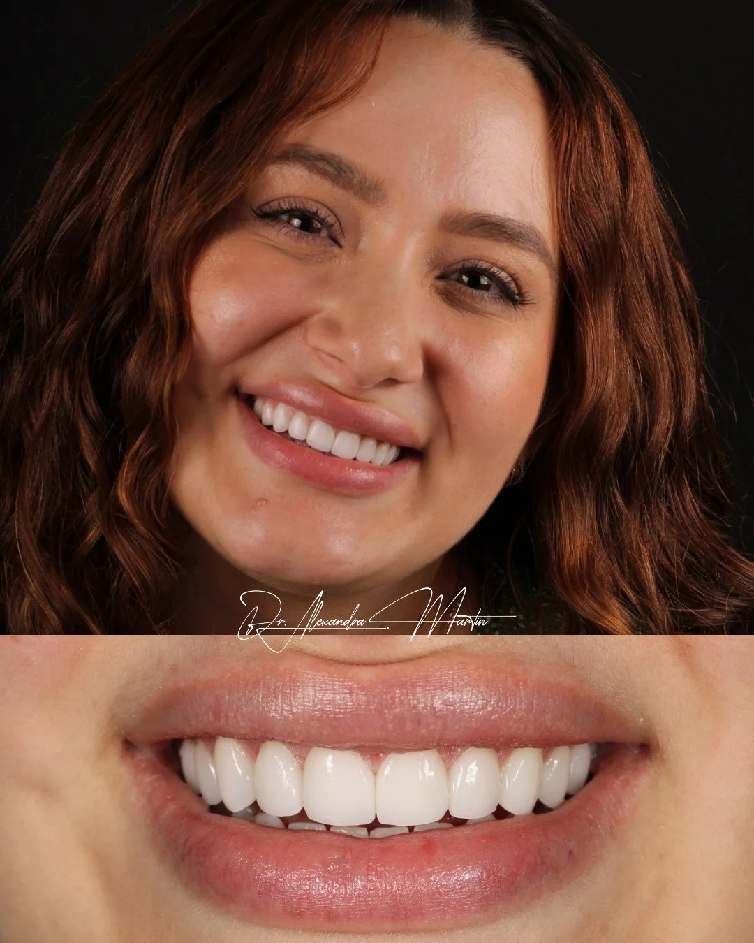 A smile can change more than appearance.⁠
⁠
When someone feels confident sharing it, their whole presence shifts. ⁠
⁠
I&rsquo;m always grateful to play a small role in that moment.⁠
#VeneerDesign #CosmeticDentistry #SmileConfidence⁠